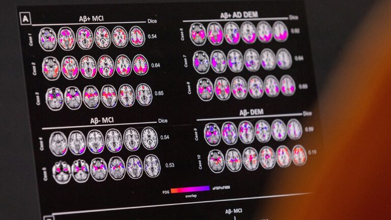 proteins-dementia.jpg