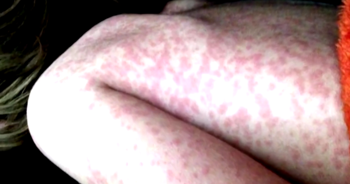 measles.png