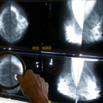 Breast_Cancer_Treatment_04215.jpg