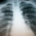 20151211__tuberculosis1.jpg