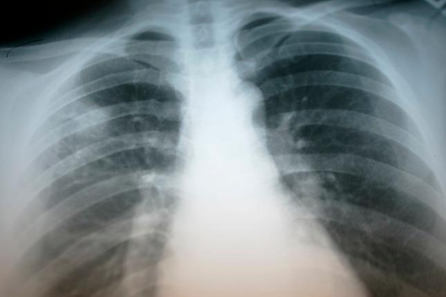 20151211__tuberculosis1.jpg